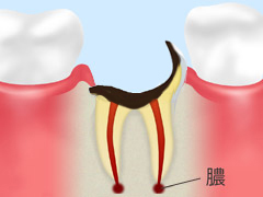 C4：歯根に達したむし歯 